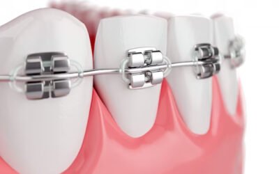 Les Enfants et l’Orthodontie : Quand Est-il Temps de Consulter un Orthodontiste ?