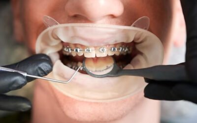 Orthodontie pour Adultes : À Quel Âge est-il Trop Tard pour un Sourire Parfait ?