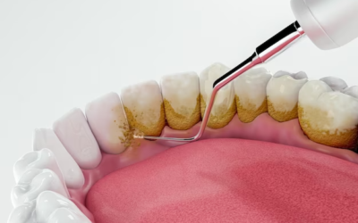Parlons Plaque Dentaire : Comprendre les Risques et la Prévention